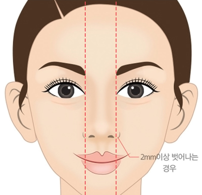 정상적인 콧볼