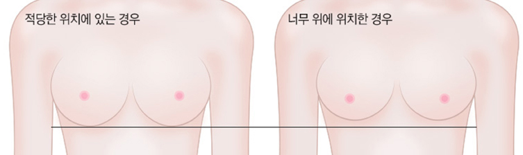 가슴확대술