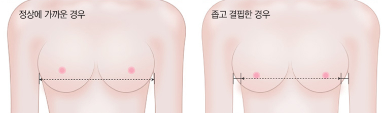 가슴확대술