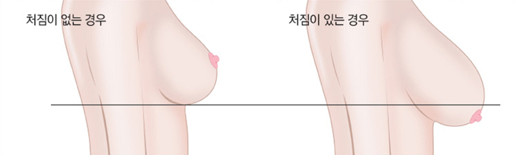 가슴확대술
