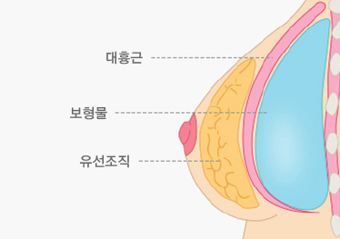 근육하 삽입법