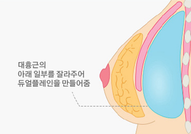 이중평면 삽입법(듀얼플레인)