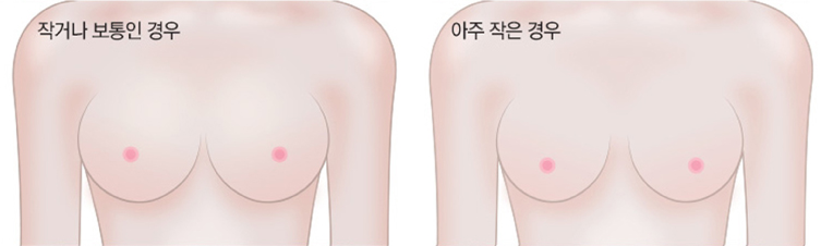가슴확대술