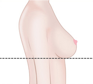 텍스쳐 보형물
