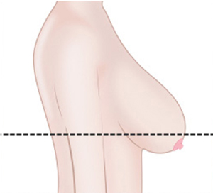 마이크로텍스쳐 보형물