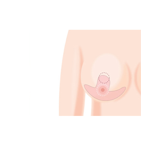 유륜절개법