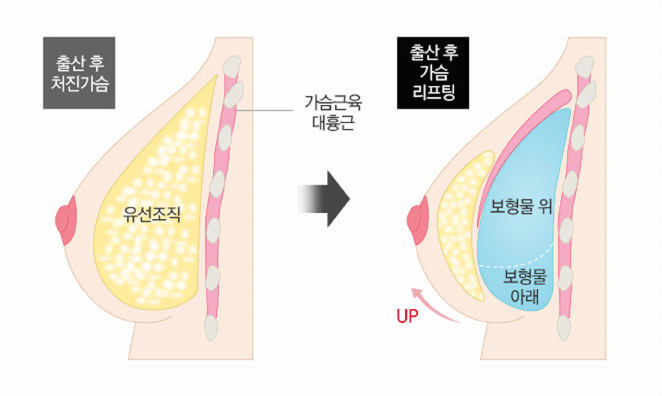 보형물 삽입