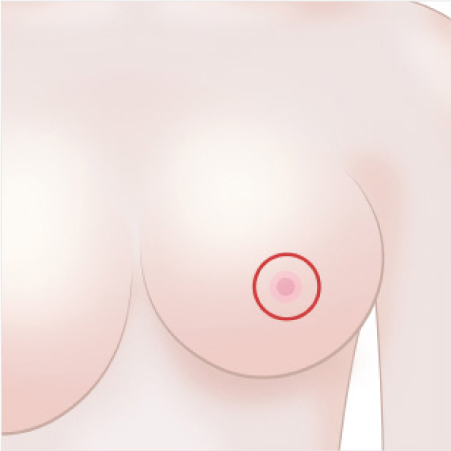유륜둘레 절개법