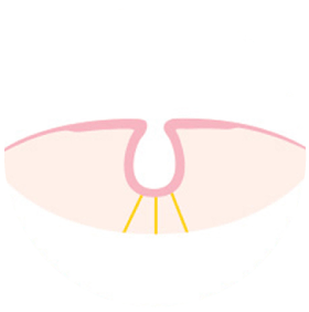 함몰유두교정 수술방법