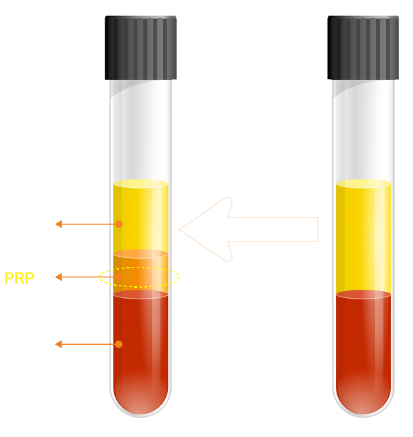 PRP