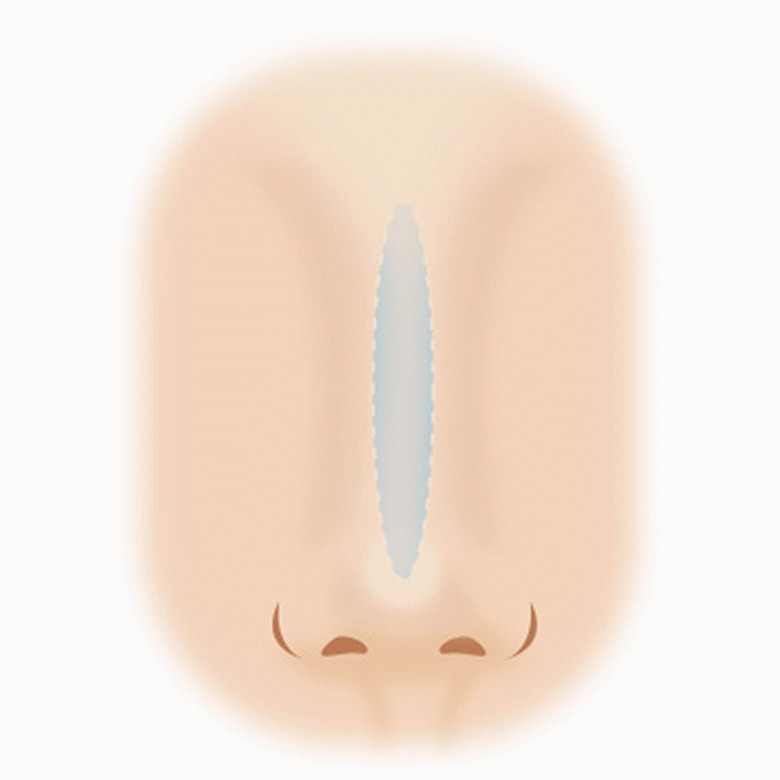 코재수술 수술방법
