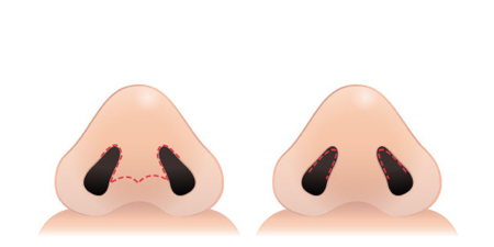 콧대성형수술방법