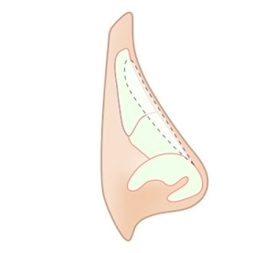 콧대성형수술방법
