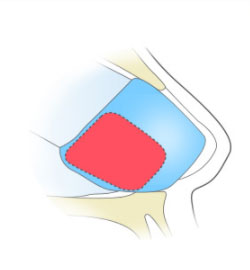 비중격