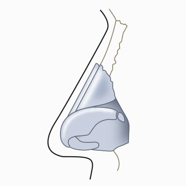 긴코수술