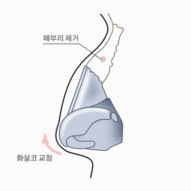 긴코수술