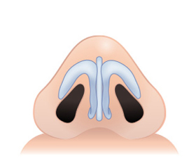 복코원인 및 유형
