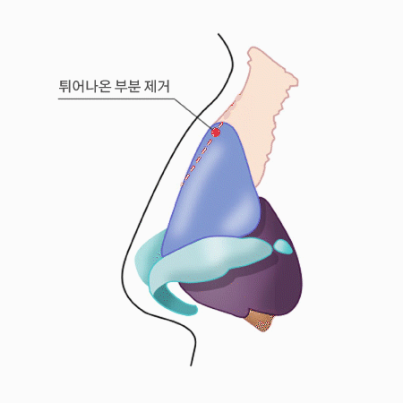 매부리코