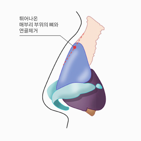 매부리코