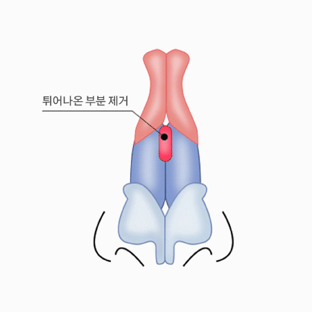 매부리코