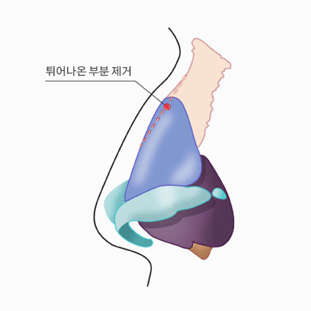 매부리코