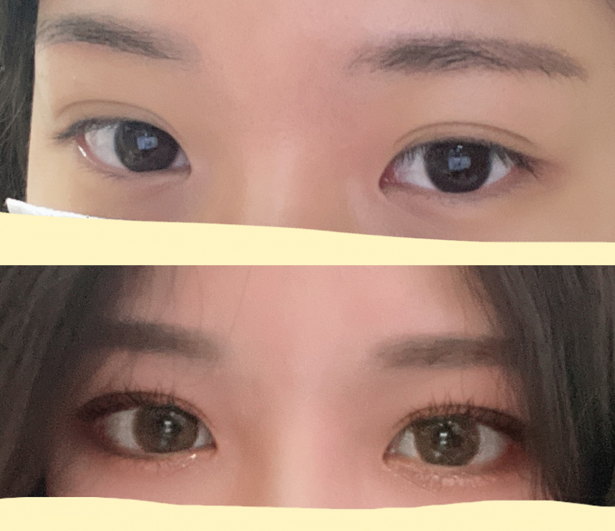 제스타 수술후기