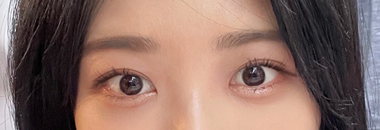 제스타 수술후기
