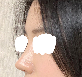 제스타 수술후기