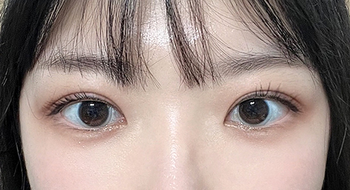 제스타 수술후기