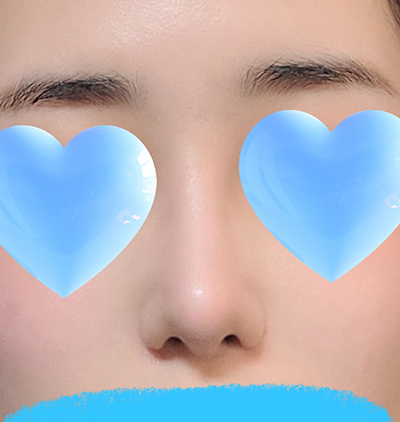 제스타 수술후기