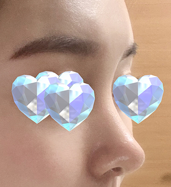 제스타 수술후기